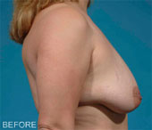 Patient # 71840 Before Photo # 5